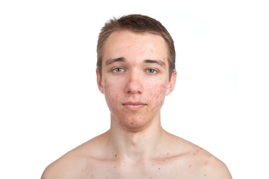 how-many-forms-of-acne-scars-are-threre