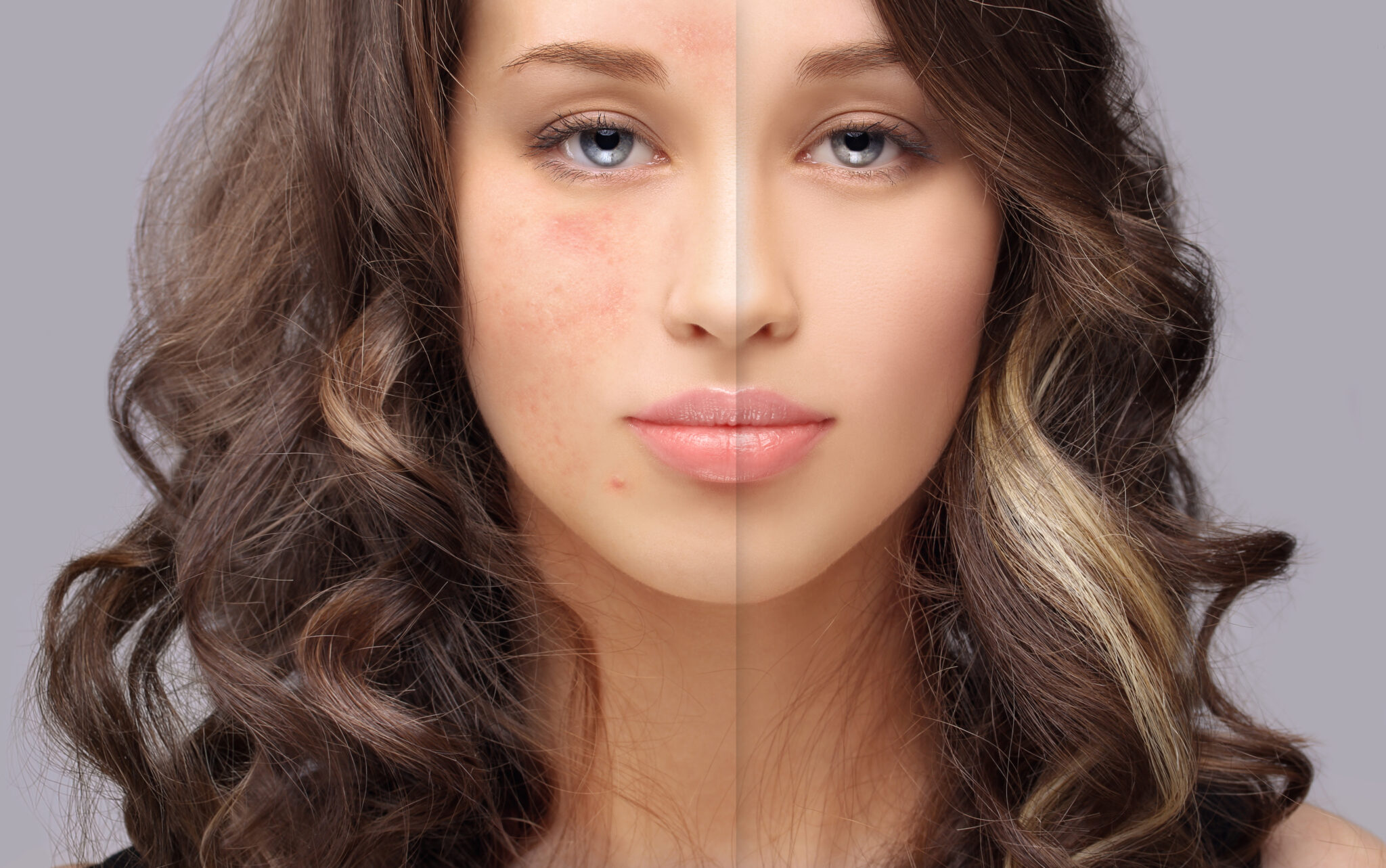 acne-how-to-get-rid-of-post-acne-red-marks-skincareaddiction